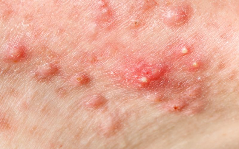 da lên mụn viêm không kiểm