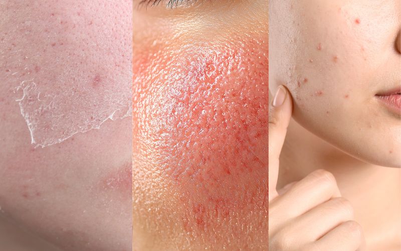 Tác dụng phụ của retinol