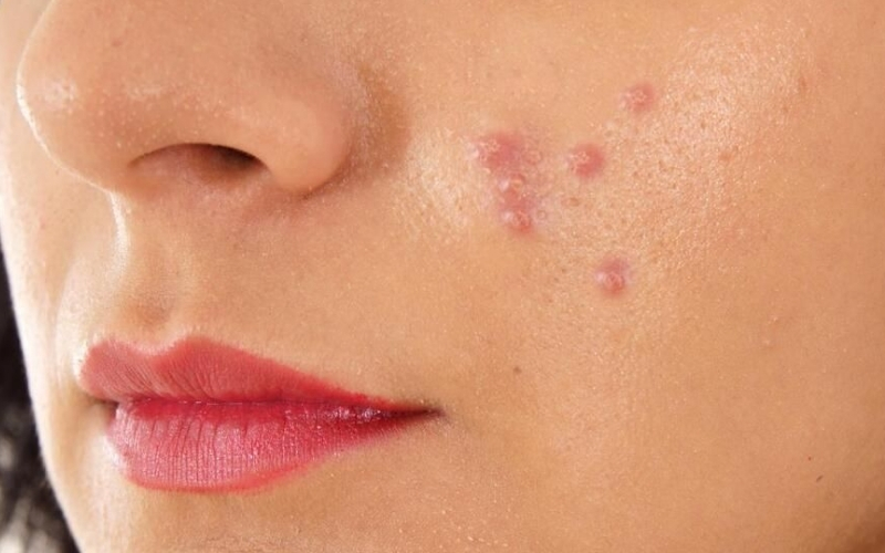 Nổi mụn do kích ứng