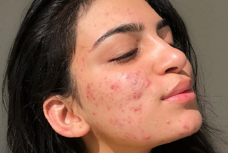 Da  bị đẩy mụnA