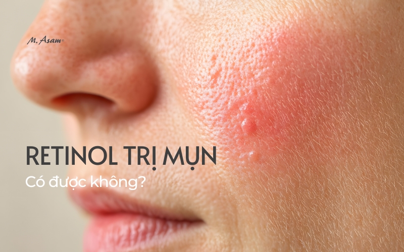 Retinol trị mụn được không