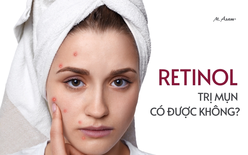 Retiol trị mụn có được không