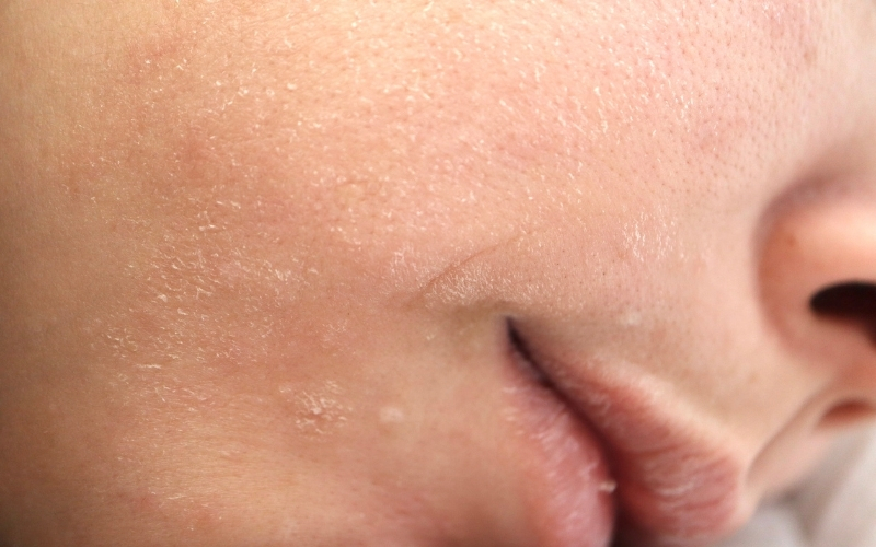 Da khô căng, bong tróc