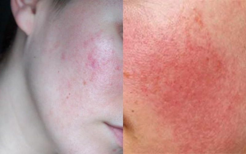 Phân biệt da bị kích ứng và dị ứng